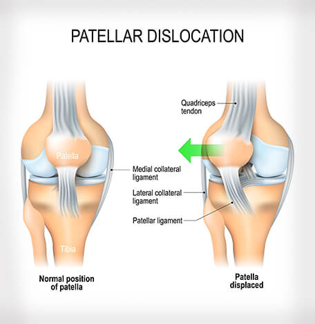 Physiotherapy in Toronto for Knee - Iliotibial Band Syndrome