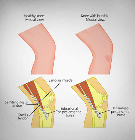 Pes Anserine Bursitis Rehab Protocol Sexiezpix Web Porn