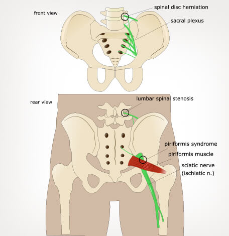 Piriformis Syndrome – Diversified Integrated Sports Clinic