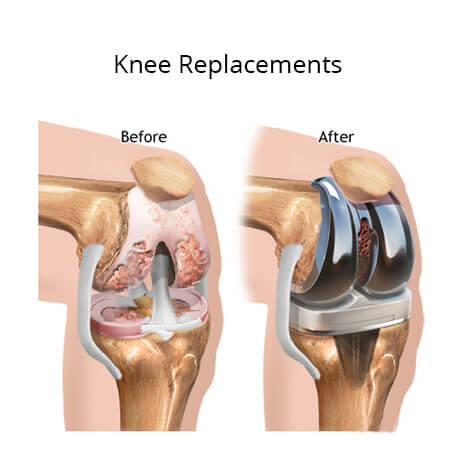 Physiotherapy in Toronto for Knee - Iliotibial Band Syndrome