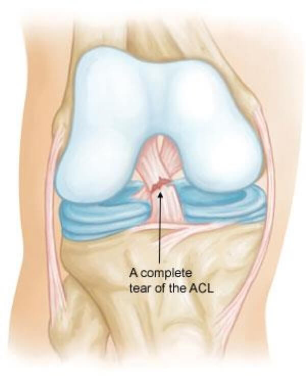 Custom Knee Brace In Toronto. For ACL, Meniscus Tear, Sport