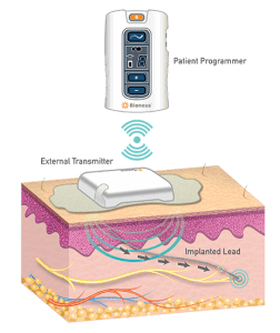 peripheral nerve stimulator peripheral nerve stimulator
