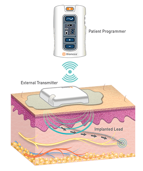 Spinal Column and Peripheral Nerve Stimulator - Back Pain Treatment